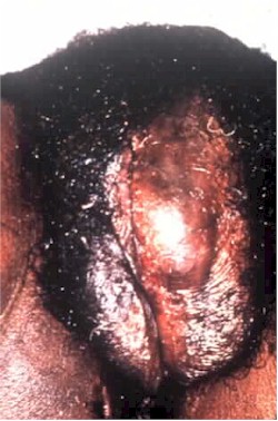 hematoma250.jpg (32660 bytes)