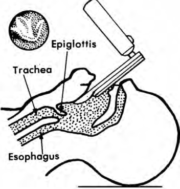 Endotracheal Intubation Visualizing the Epiglottis