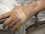 IV line in back of hand