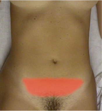 Area of pain with pelvic inflammatory disease