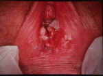 Vulvar Condyloma