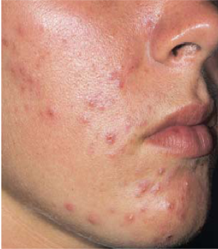 Inflammatory Acne - Proactiv Plus Acne Treatment