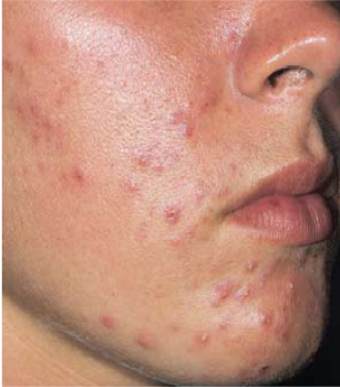 Inflammatory Acne