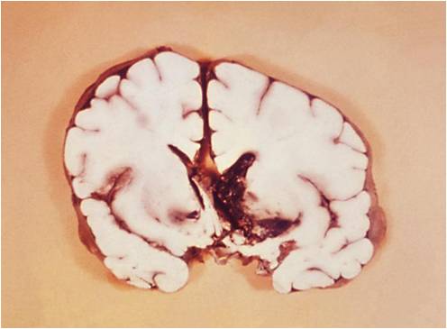 Interventricular hemorrhage in the brain