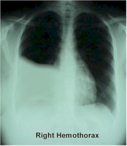 Right hemothorax