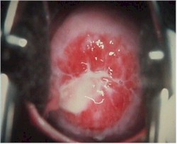fleshy-tissue-discharge-during-period