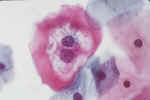 HPV_Koilocyte.jpg (24487 bytes)