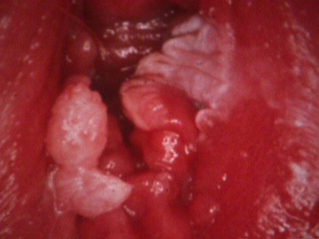 a vulvar condyloma oka