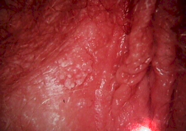 a vulva és a hüvely condyloma