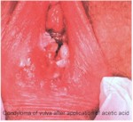 Condyloma on the hymeneal ring