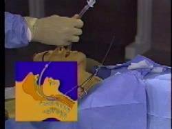 Retrograde endotracheal intubation